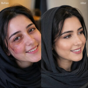 جامع ترین راهنمای میکاپ مناسب صورت با کبودی پوست: هنر پوشاندن عیوب با تکنیک های حرفه ای